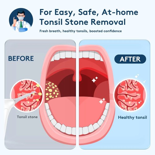 Набір для видалення каміння з мигдаликів Tonsil Stone Remover Kit Electronic Vacuum White